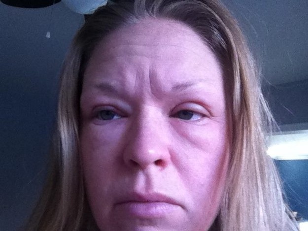 Allergic Reaction to Neutrogena Makeup Remover Wipes