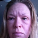 Allergic_reaction_to_neutrogena_makeup_remover_wipes